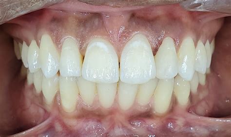 Orthodontic Treatments Before & After | Apple Dental Centre | Dentist ...