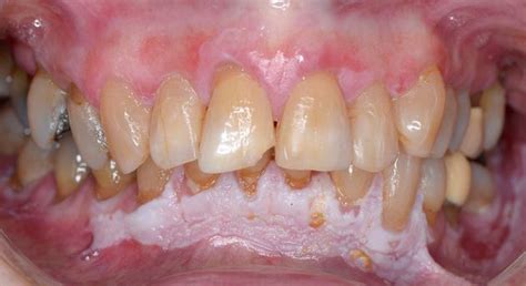 Proliferative Verrucous Leukoplakia – OPMDCARE