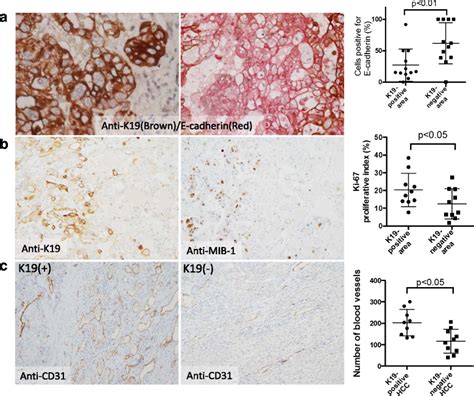 Immunohistochemical Analysis Of Human Hcc Specimens A Double Download Scientific Diagram