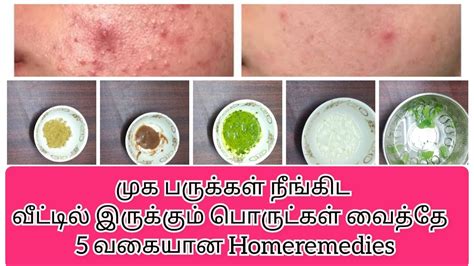 How To Remove Pimples 5 Tips Homeremedies முக பருக்கள் நீங்கிட 5 வகையான Homemade Tips Tamil