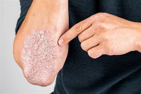 Triggers And Treatments For Psoriasis Easton Dermatology Associates