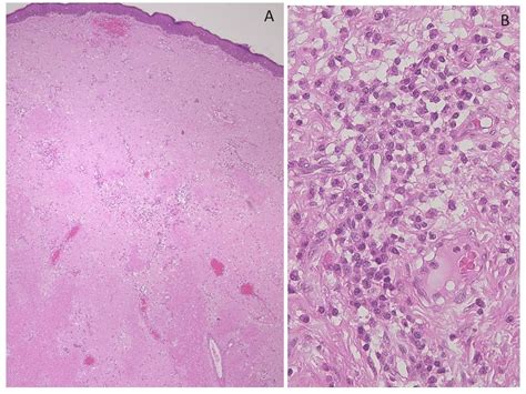 Nodular Amyloidosis