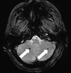 Brain MRI showing multiple cavernomas | Download Scientific Diagram