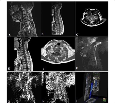 A 45 Years Old Female Patient Presented With Progressive Quadriparesis Download Scientific