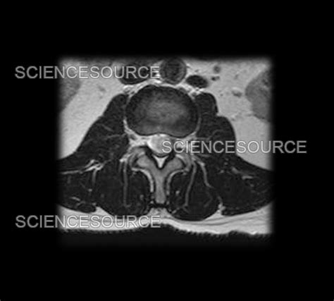 Photograph | MRI of Lumbar Schwannoma | Science Source Images