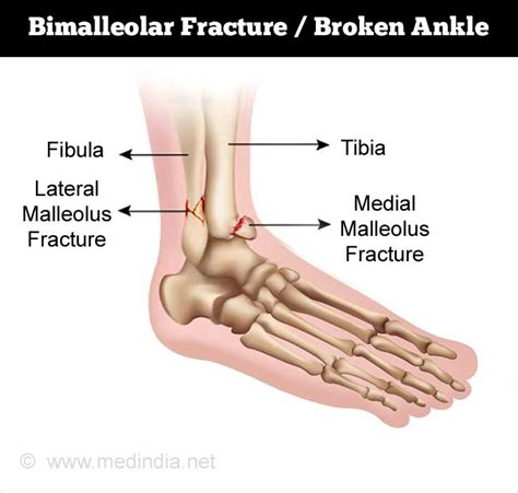 Bimalleolar Fracture Broken Ankle Causes Symptoms Diagnosis Treatment