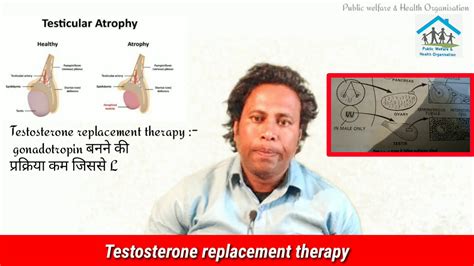 Testicular Atrophy अंडकोष का आकार छोटा बड़ा होना कारण लक्षण Youtube