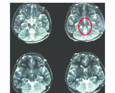 Non-contrast axial T2-weighted MRI of patient 1 at the level of ...