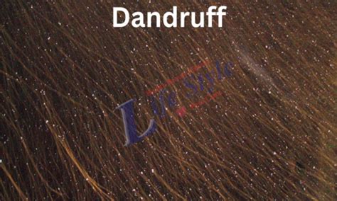 Dandruff Causes Signs And Treatment By Try It Life Style Baskadia