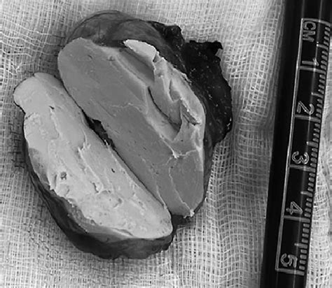 The Intact Dermoid Cyst Postoperatively Figure 4 The Dermoid Cyst