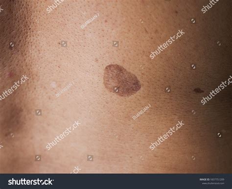 Dark Skin Mole Birthmark Man Texture Stock Photo 1837751209 Shutterstock