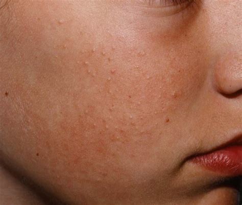 Ciltte tavuk derisi görünümü nasıl geçer Keratosis pilaris nedir