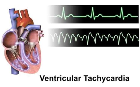 Ventricular Tachycardia: Causes, Symptoms, And Treatment » 2023