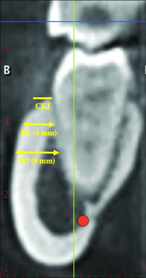 Tomographic mapping of buccal shelf area for optimum placement of bone screws: A three ...