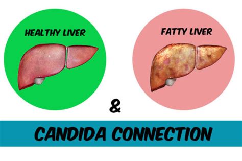 Fatty Liver And Candida Infection Is It Connected Yeastinfection Your Source For