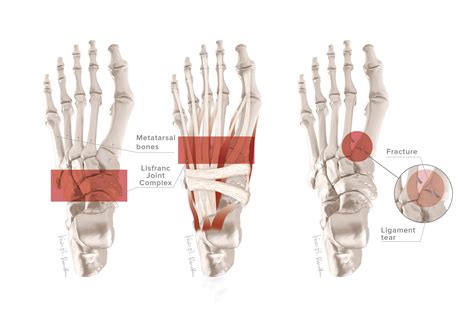 Lisfranc Injuries Kevinroot Medical