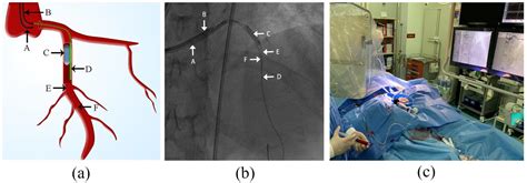 Jcm Free Full Text A Novel Reperfusion Strategy For Primary