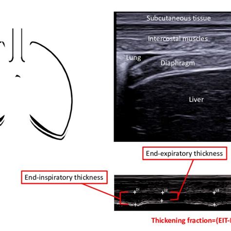 Ultrasonographic Assessment Of Diaphragm Thickness And Thickening