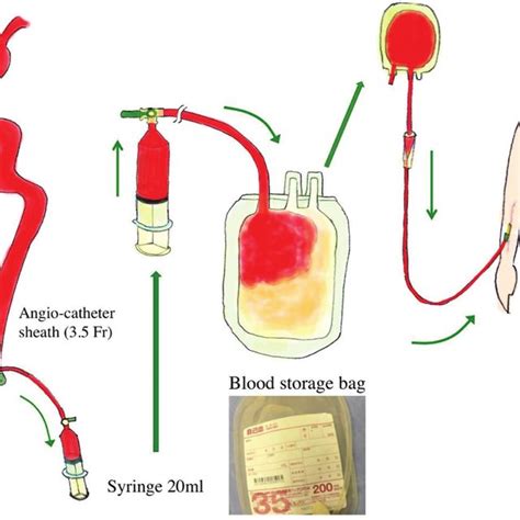 Pdf Autologous Transfusion Of Blood Aspirated During Suction