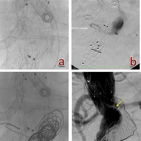 Sequence of technical steps during the embolization procedure. (A)... | Download Scientific Diagram