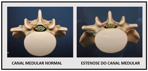 Estenose Lombar Medicina de Excelência Ortopedista