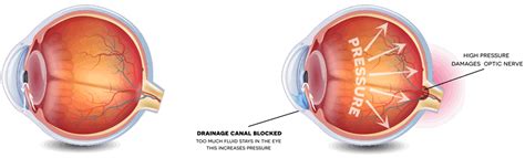 Glaucoma