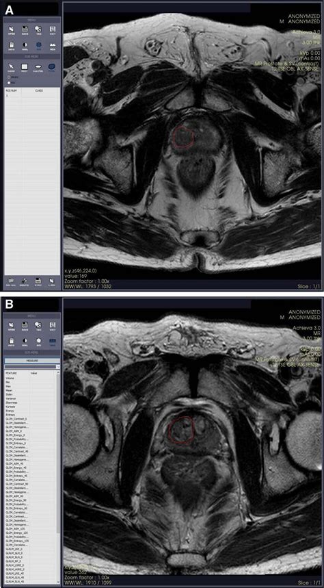 Representative Roi Drawings Of Benign Prostate Hyperplasia According To Download Scientific