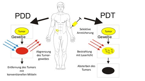 Photodynamische Therapie PDT Zur Fokalen Prostatakrebs Behandlung