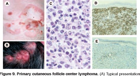 Table 2 From WHO EORTC Classification For Cutaneous Lymphomas