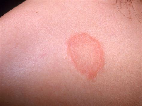 Red Circular Rash Pictures Photos