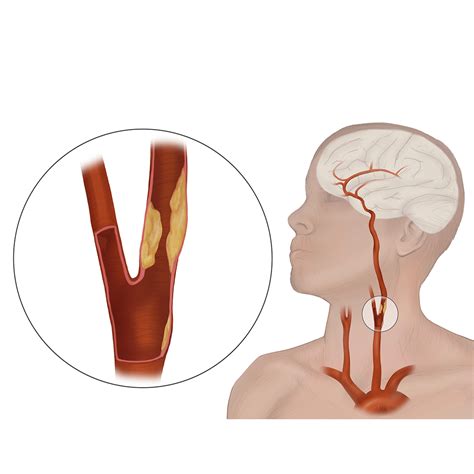 Stenosi Carotidea Sintomi Cause Trattamento Ipazia Dcc It