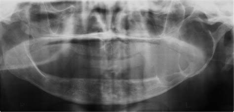 Conventional Panoramic Radiograph Revealing Multilocular Osteolytic