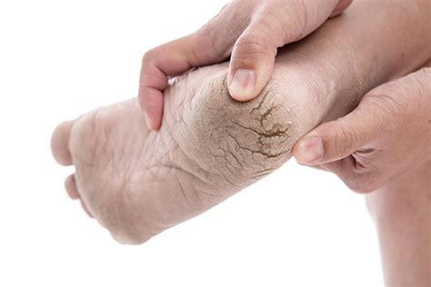 Cracked Heels And Heel Fissures Wanneroo Podiatry