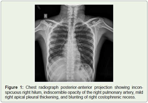 A Rare Case Of Isolated Proximal Interruption Of The Right Pulmonary Artery