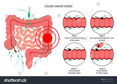 3,168 Transverse colon Images, Stock Photos & Vectors | Shutterstock