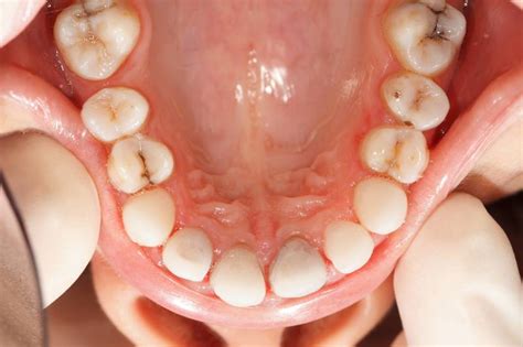 Caries Interdentales Qué Son Tratamiento Y Cómo Detectarlas Axioma