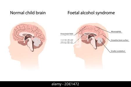 Illustration Of Baby With Fetal Alcohol Syndrome Fetal Alcohol