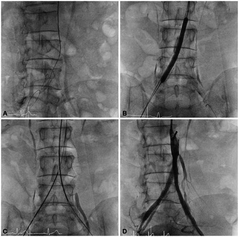 Successful Complete Revascularization And The Final Results A