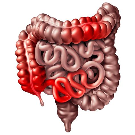 Enfermedad de Crohn Estos son síntomas a los que debes estar atento