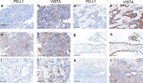 Representative Immunohistochemical Staining Of V Domain Ig Suppressor