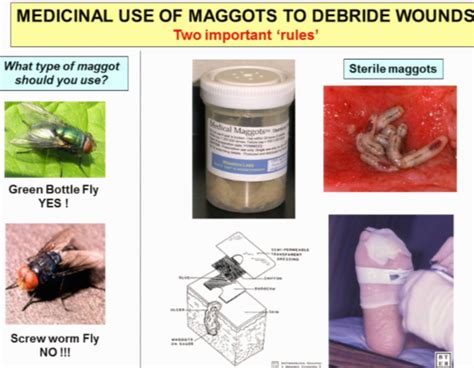 Maggot therapy Flashcards | Quizlet