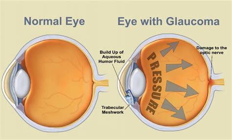 Glaucoma Vision : Causes of vision loss worldwide — м.: