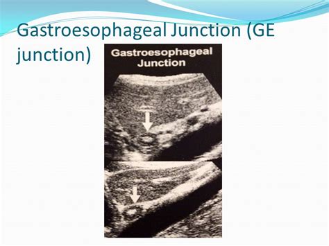 Gastroesophageal Junction Ultrasound