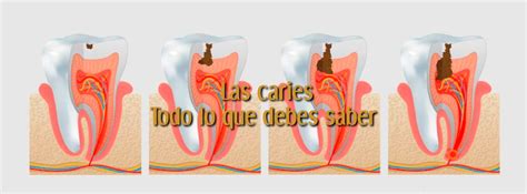 La Caries Dental S Ntomas Causas Prevenci N Y Tratamientos