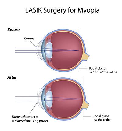 Lasik Eye Surgery Cost in India - Best Eye Hospitals in India