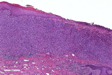 Pathology Outlines Vulvar Melanoma