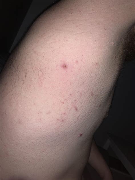 Scabies? Itching about 2months. : r/scabies