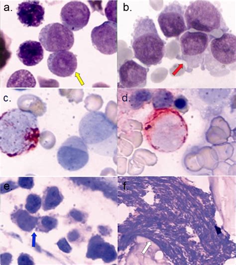 De Novo Acute Megakaryoblastic Leukemia With P210 Bcrabl And T116