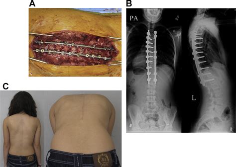 Management Of Scoliosis Advances In Pediatrics