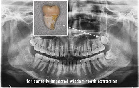 Fully Buccolingually Impacted Wisdom Tooth